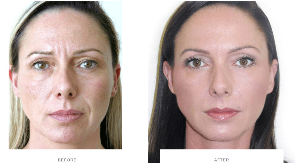 Botox 11 lines, frown lines botox before and after
