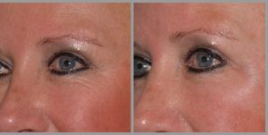 Botox eye wrinkles before and after results