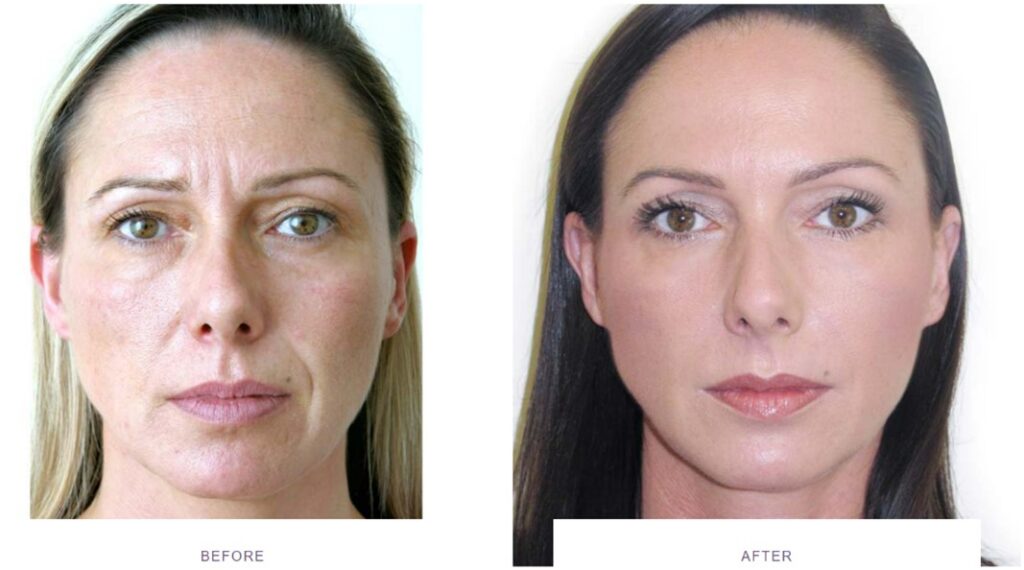 Botox face before and after - Buckinghamshire