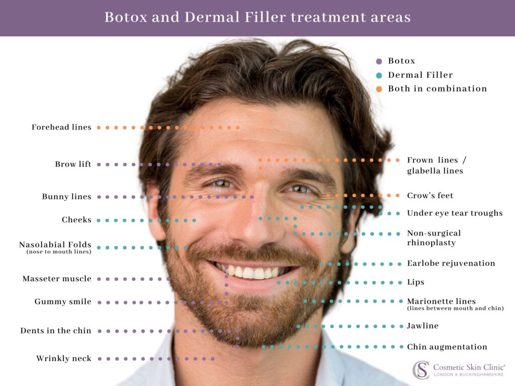 Botox for men treatment areas - Botox men areas - Mens botox areas