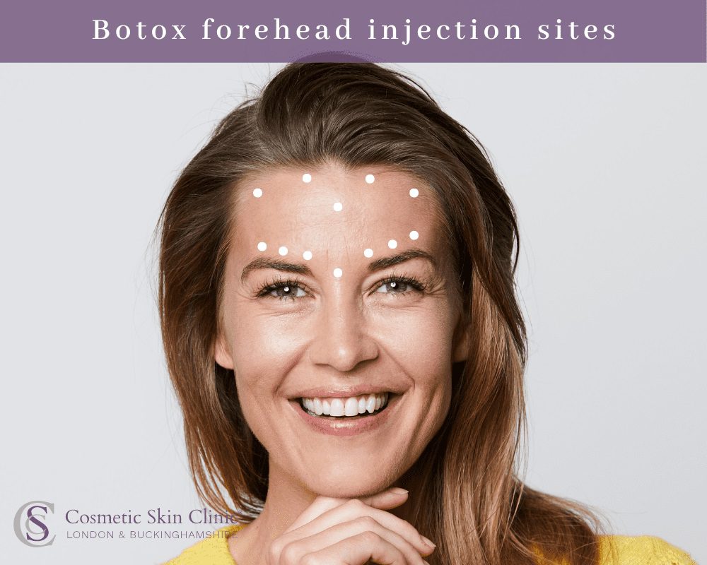 botox injection points forehead