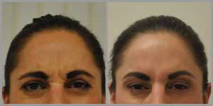 Botox frown lines before and after results