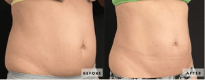 coolsculpting