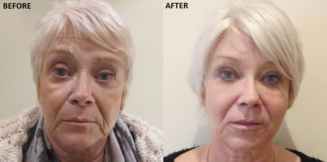 Carole Spencer Anti Ageing Treatment Before After