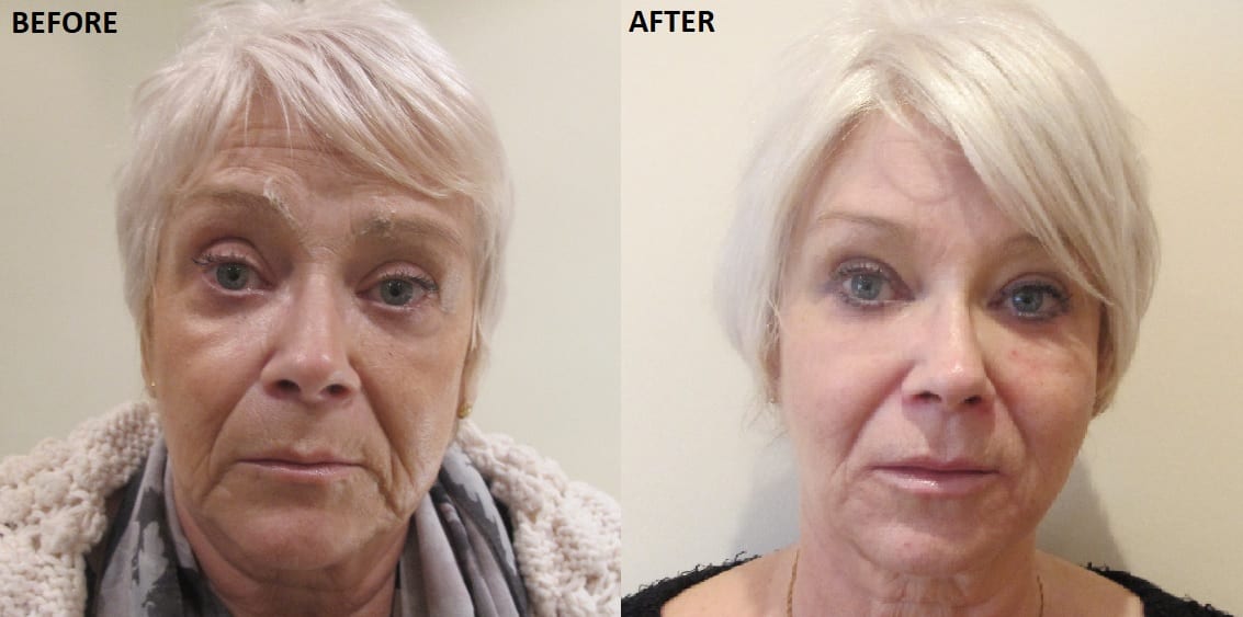 Anti Ageing Treatment 60s+ Before After Carole Spencer Anti Ageing Treatment Before After
