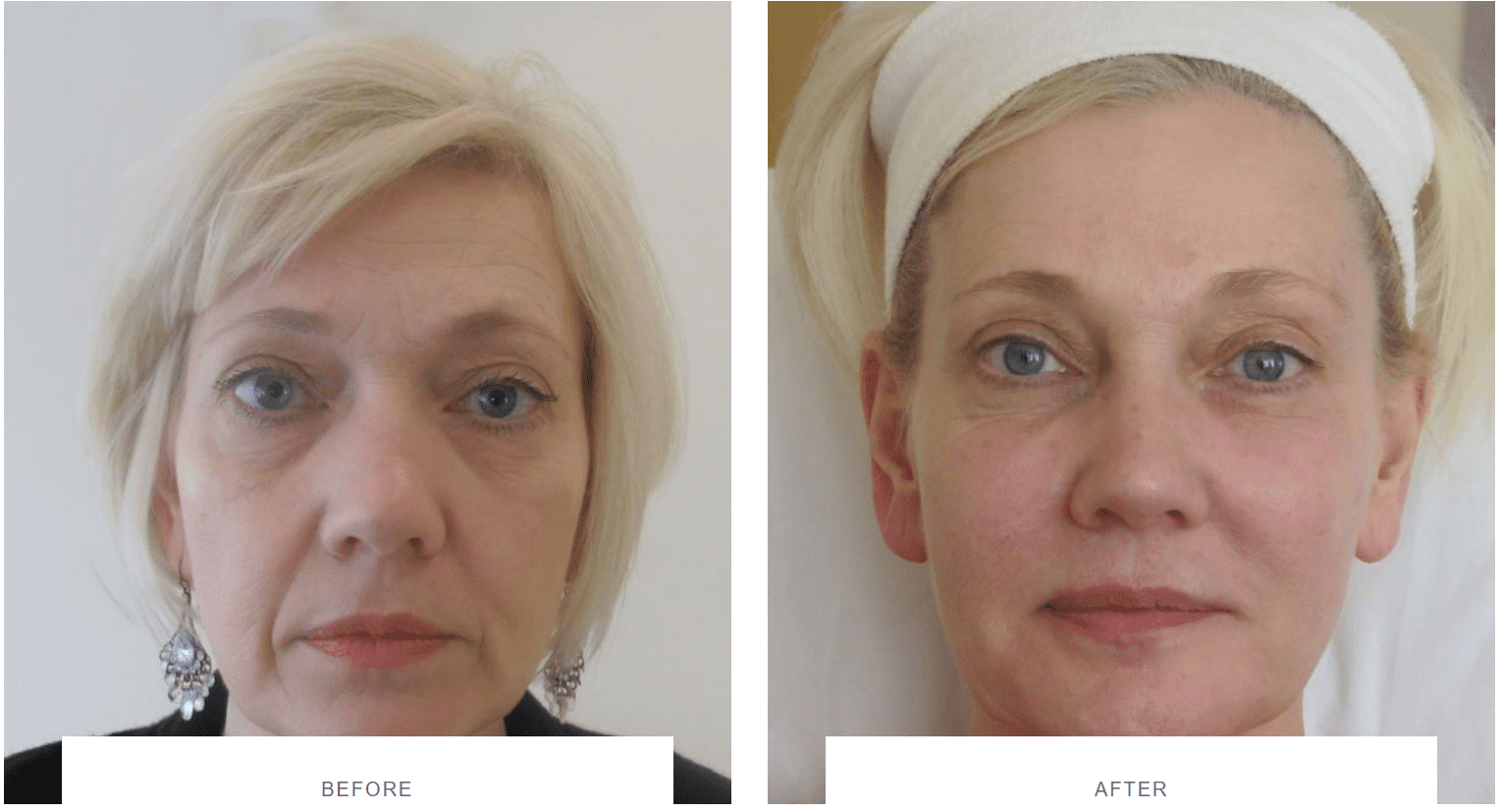 facial rejuvenation with fillers before after