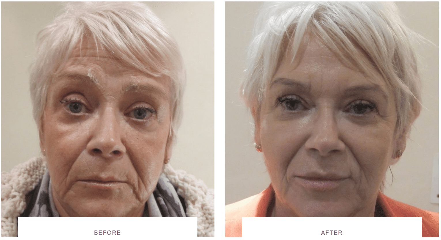 full face rejuvenation with the Juvederm® Vycross dermal fillers before and after