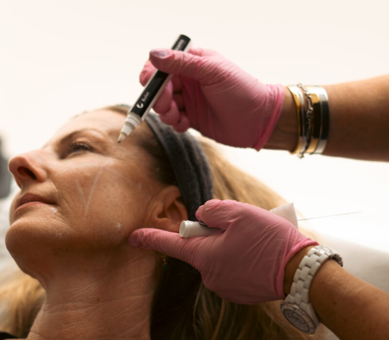 Chin Fillers The Cosmetic Skin Clinic