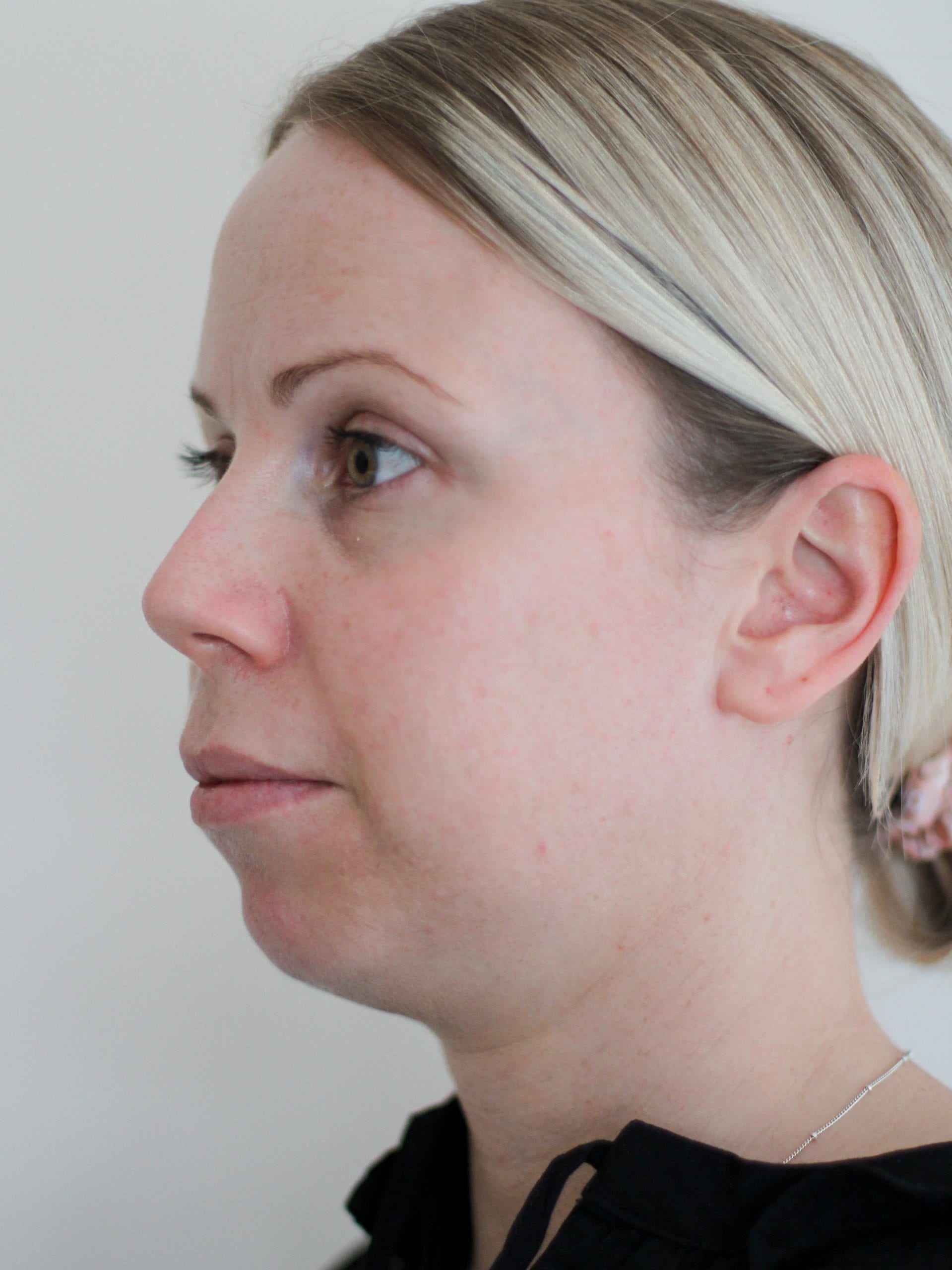 Before Chin fillers treatment