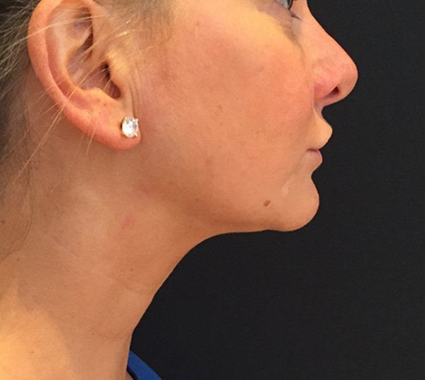 CoolMini treatment double chin after
