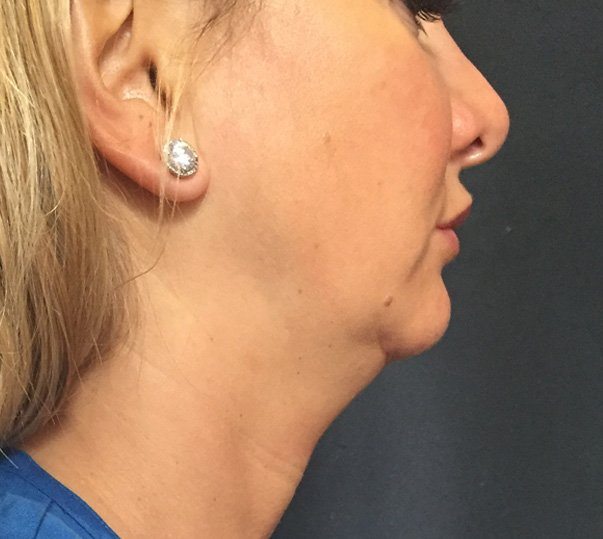 CoolMini treatment double chin before