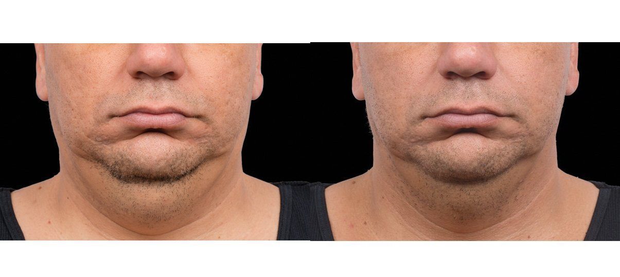 coolmini before and after double chin fat under chin