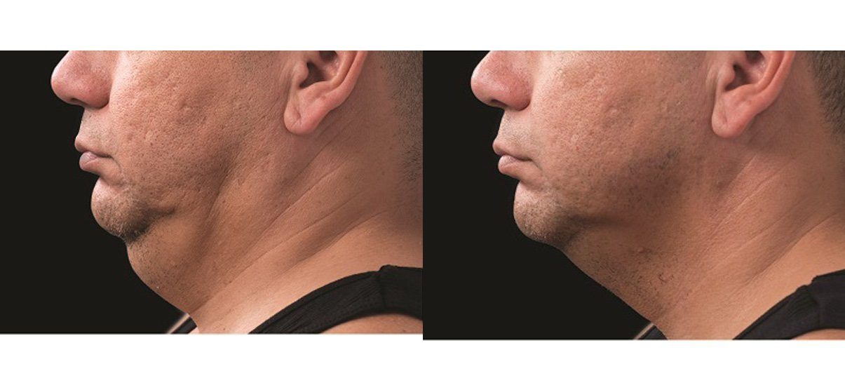coolmini fat freezing on the chin before and after
