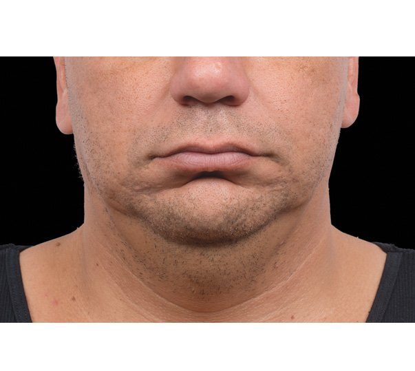 After CoolSculpting treatment to the submental (double chin)