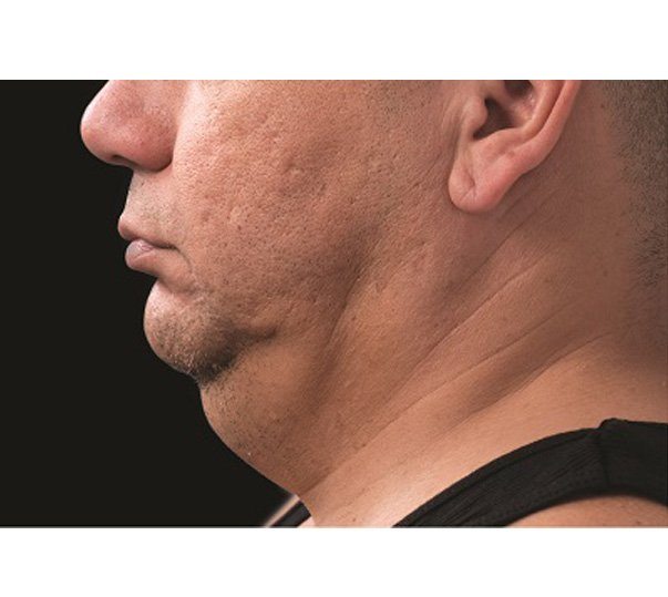 Before CoolSculpting treatment to the submental (double chin)