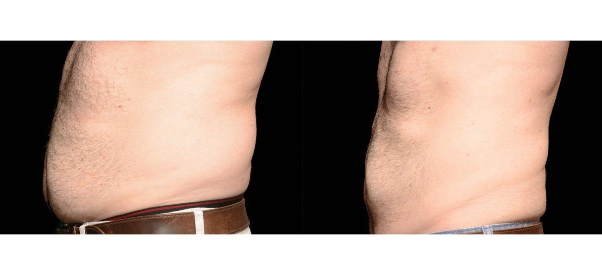 coolsculpting abdomen before and after