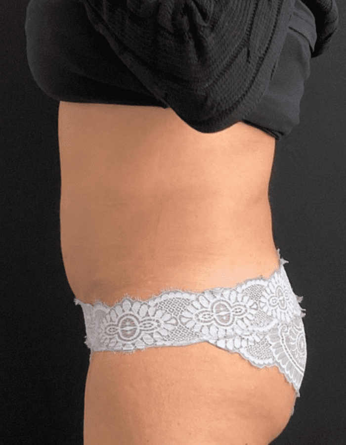 CoolSculpting Abdomen CSC After