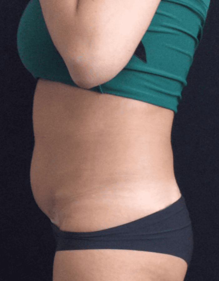 CoolSculpting Abdomen CSC Before