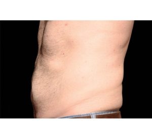 CoolSculpting-After-Abdomen