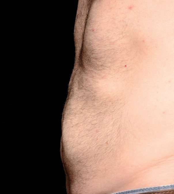 Gentleman after CoolSculpting treatment on his abdomen by Brian Biesman, MD