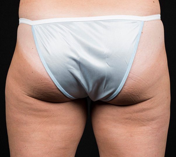 A lady before undergoing CoolSculpting treatment on her outer thighs