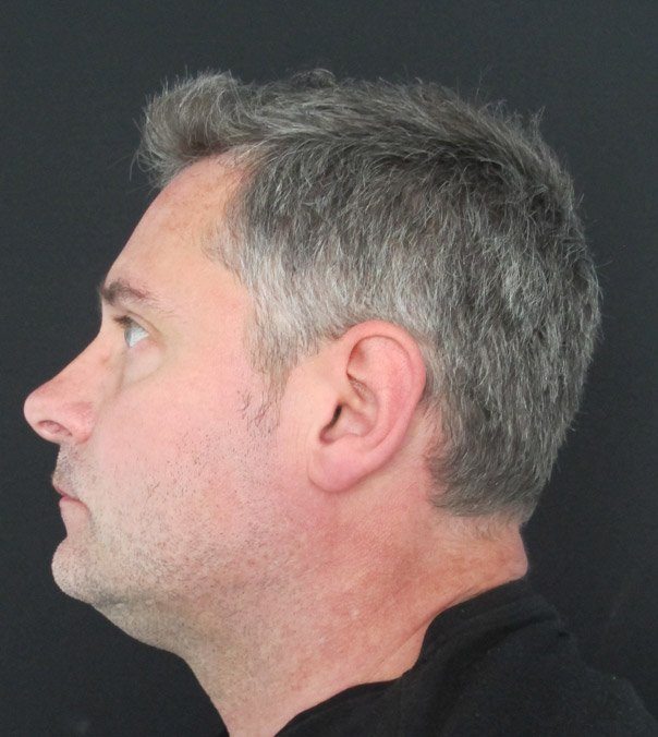 A gentleman following CoolSculpting treatment for a double chin