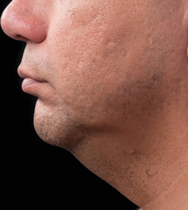 After CoolSculpting treatment to the submental (double chin)