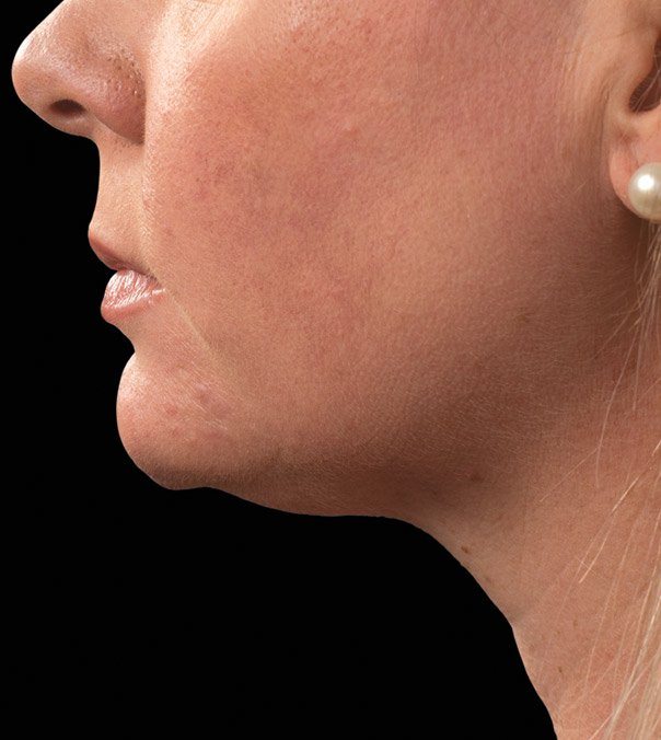 After CoolSculpting treatment to the submental (double chin)
