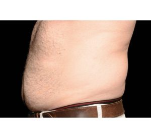 CoolSculpting-Before-Abdomen