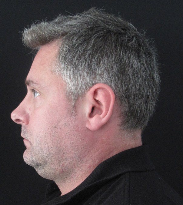 A man before undergoing fat-freezing treatment for a double chin