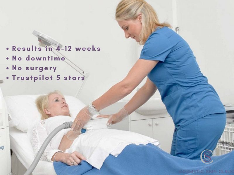 CoolSculpting Before and After Photos London Bucks