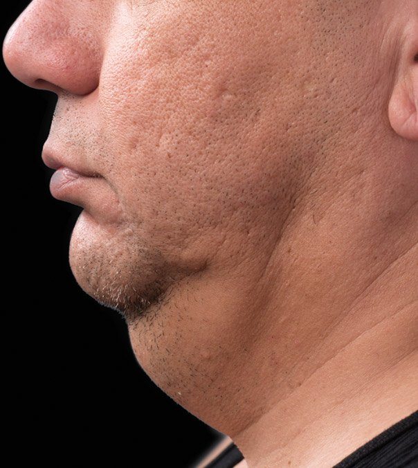 Before CoolSculpting treatment to the submental (double chin)