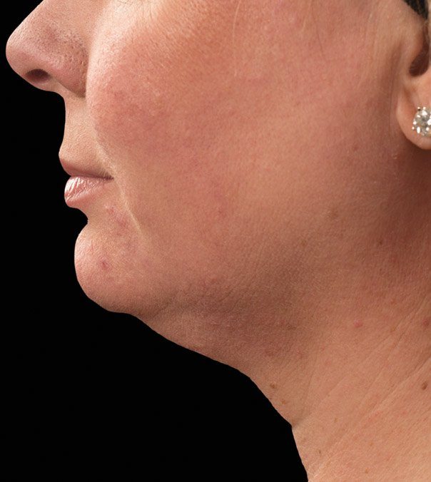 Before CoolSculpting treatment to the submental (double chin)