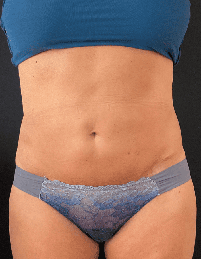 CoolSculpting Belly Fat After