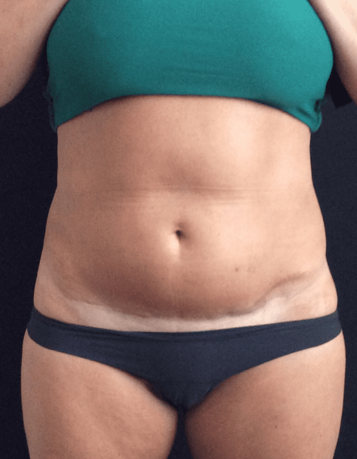 CoolSculpting Belly Fat Before