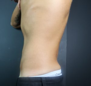 CoolSculpting Belly fat after