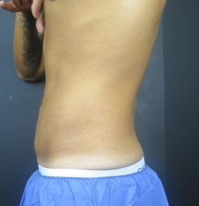 CoolSculpting Belly fat before