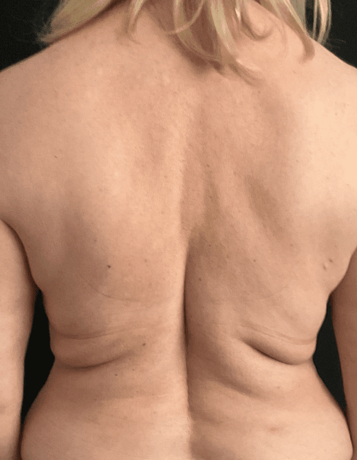CoolSculpting Fat Freezing Back Fat After