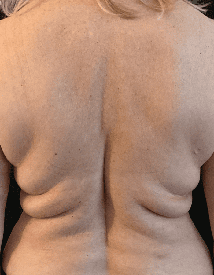 CoolSculpting Fat Freezing Back Fat Before
