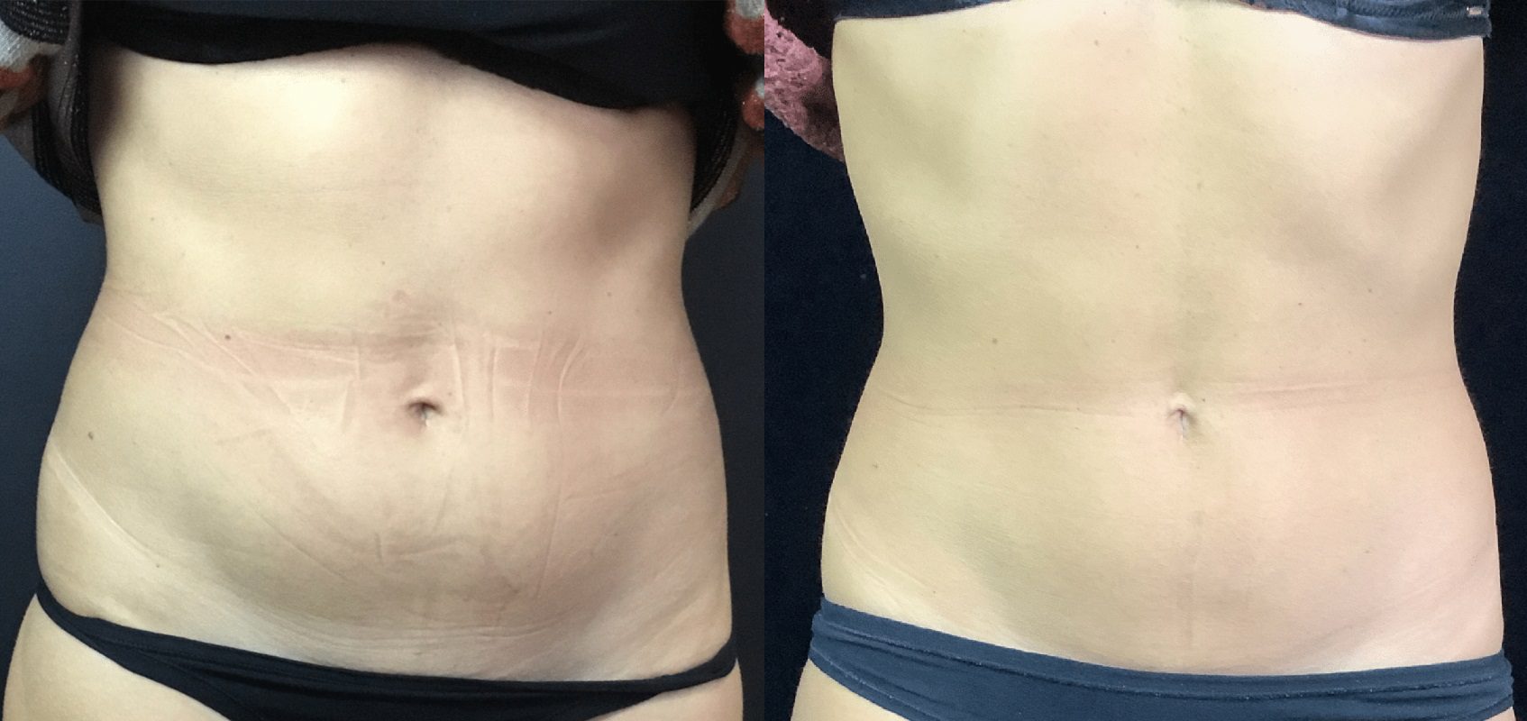 CoolSculpting Fat Freezing Belly fat Before and After - Magda