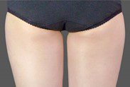 CoolSculpting Fat Freezing Inner Thigh Fat After