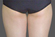 CoolSculpting Fat Freezing Inner Thigh Fat Before
