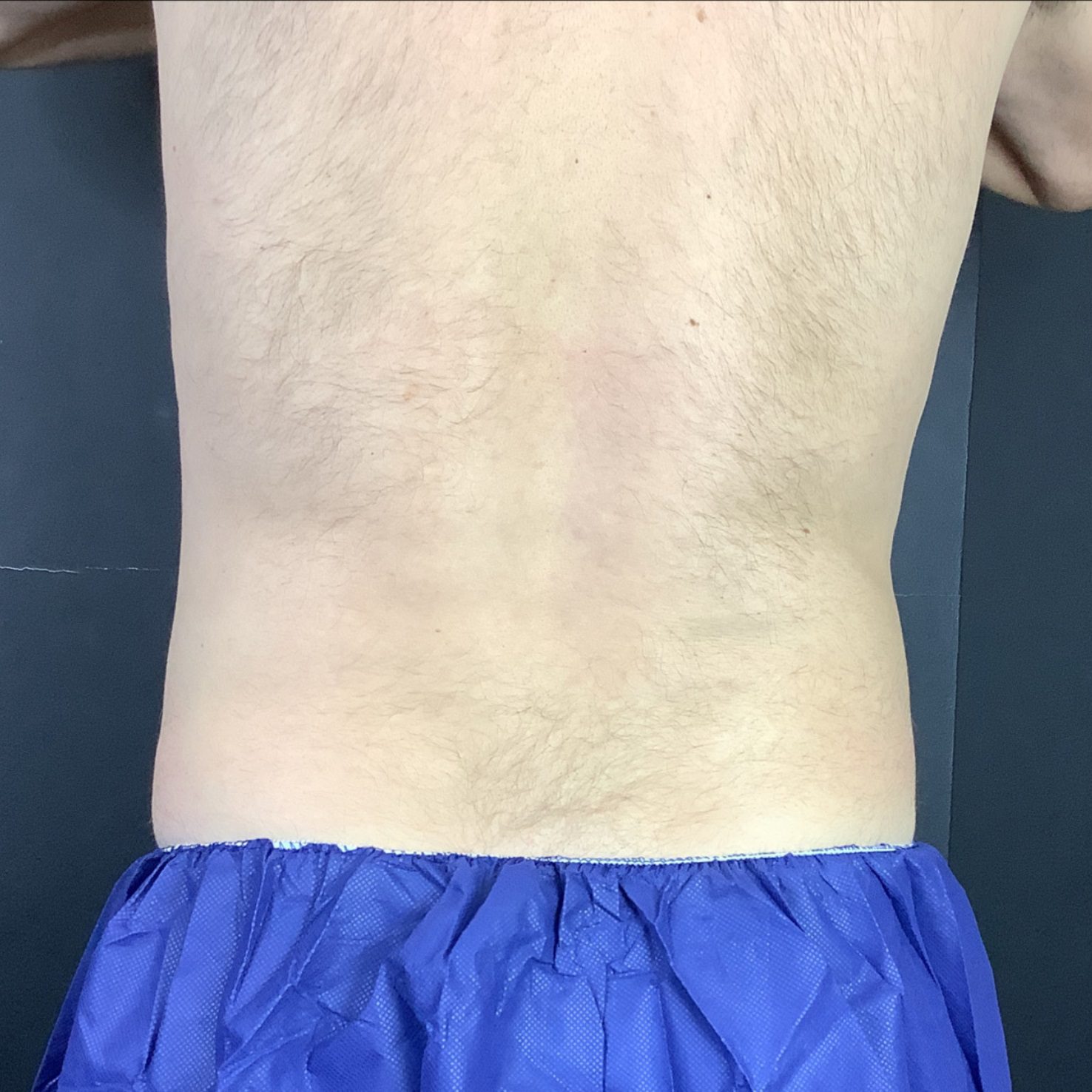 coolsculpting muffin top, flanks after
