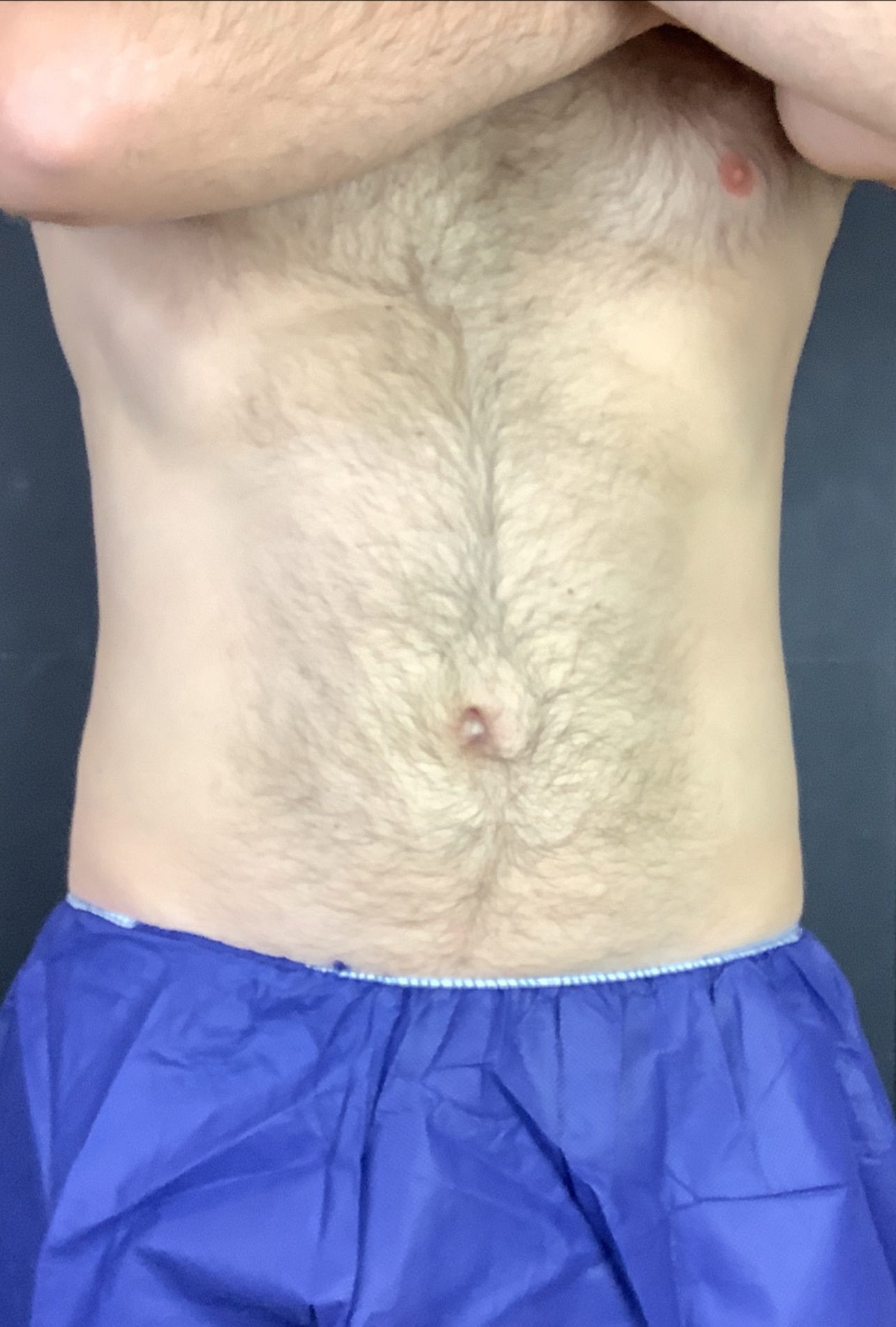 coolsculpting fat freezing flanks after