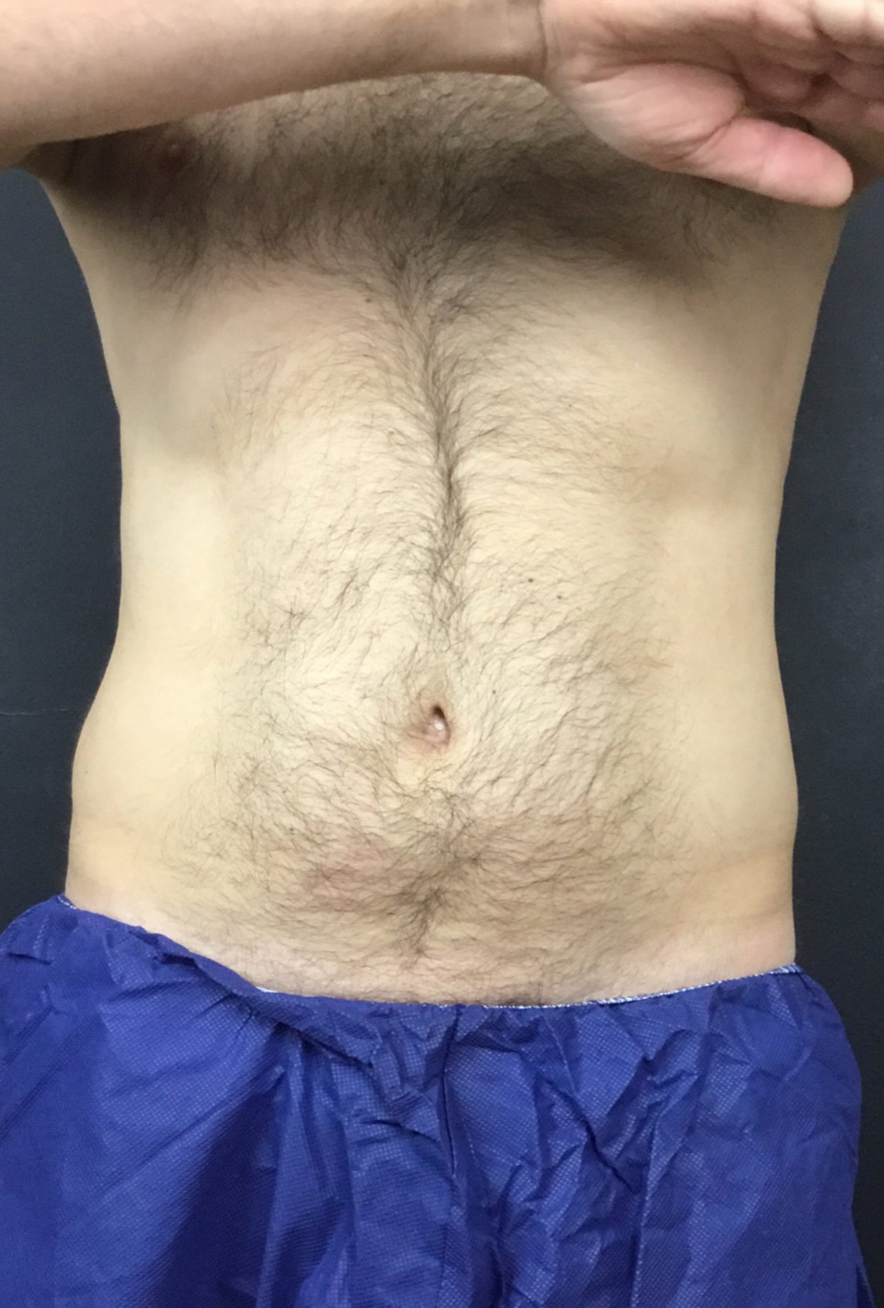 coolsculpting fat freezing flanks before
