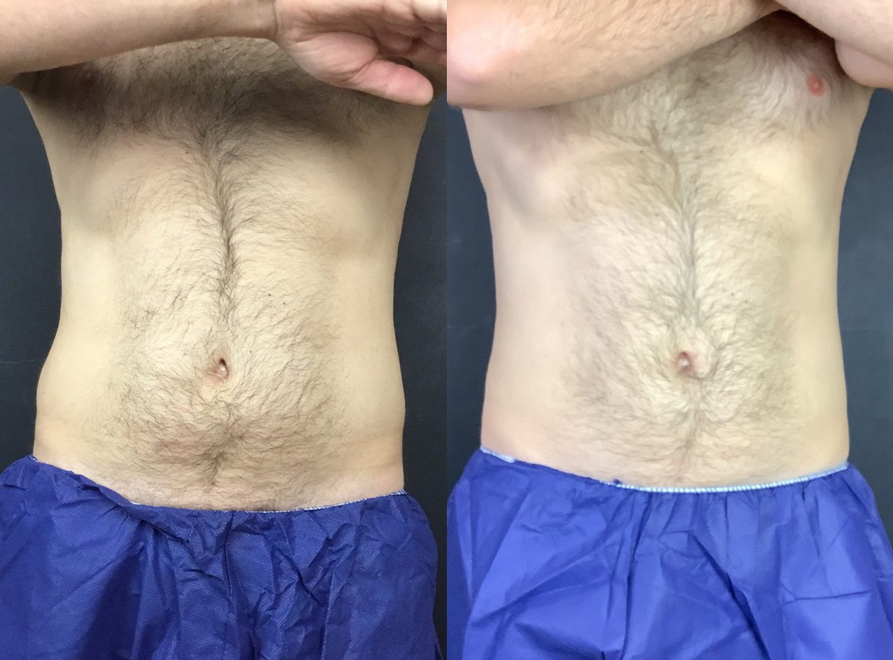 coolsculpting before and after flanks