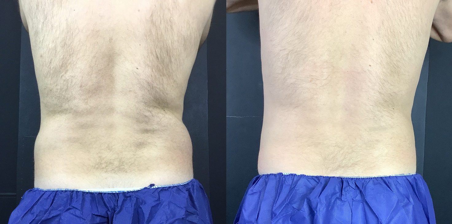 coolsculpting flanks before and after back