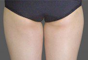 Inner Thigh Fat Removal London Bucks Thigh Lift London The