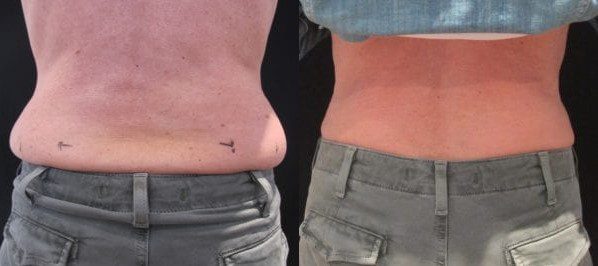 coolsculpting men london before and after, coolsculpting muffin top before and after
