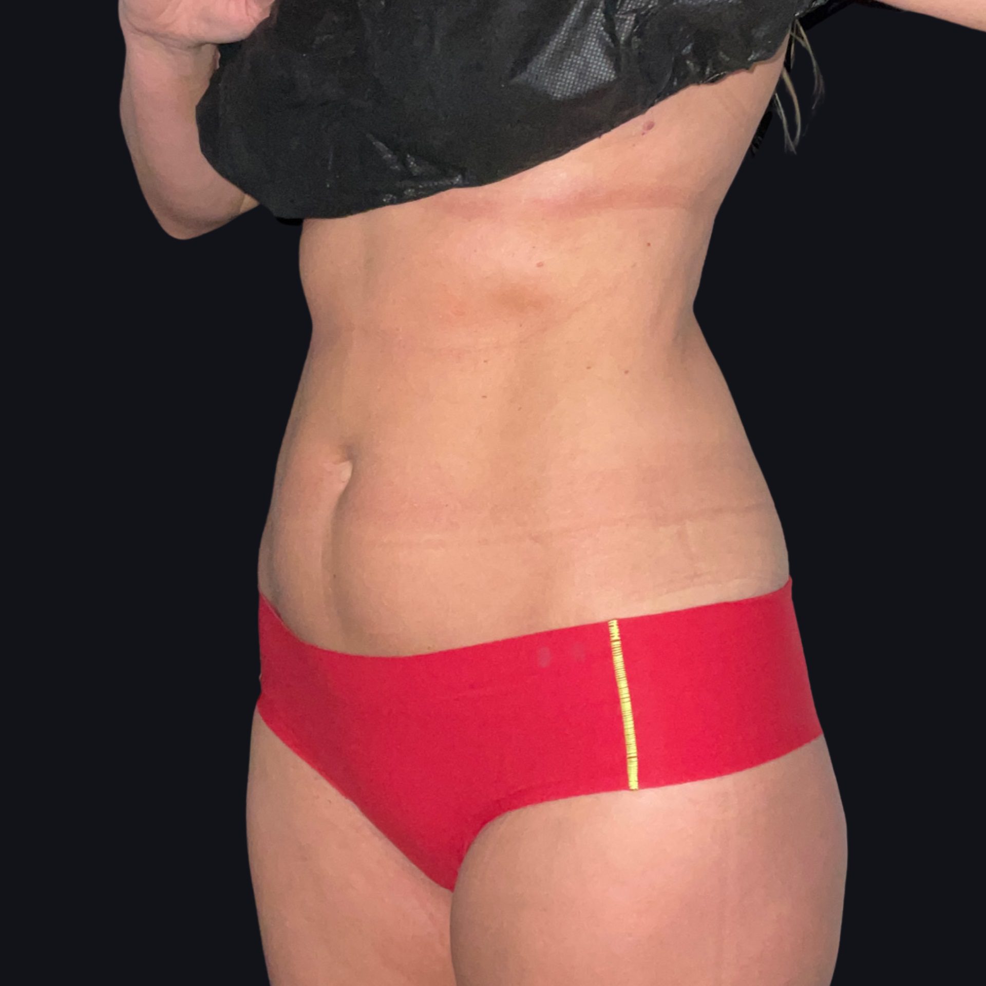 CoolSculpting Side After By Ria Murch